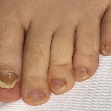 Fungal Nail Treatment