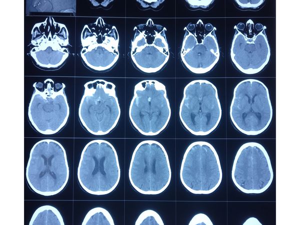 
Placas neuríticas, placas seniles o placas amiloides