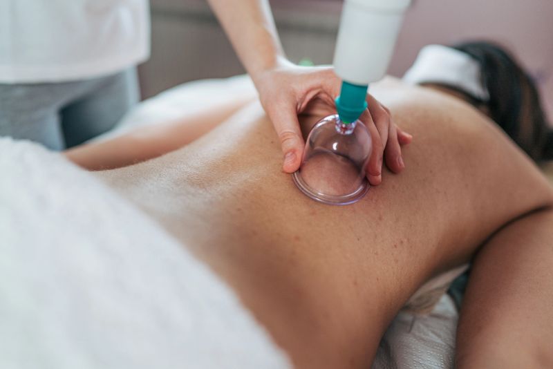 Female masseuse is using a suction cup device on the back of a female patient during a cupping therapy session at a spa or wellness center, promoting relaxation and pain relief