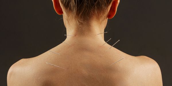 Person receiving acupuncture treatment on their upper back and neck.