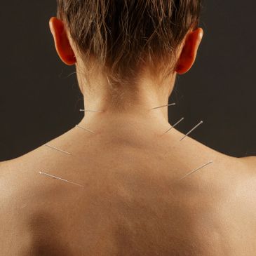 Person undergoing acupuncture on neck and shoulders.