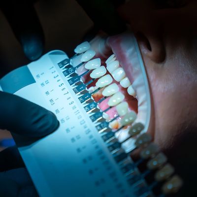 Image of patient's teeth next to a shade guide.