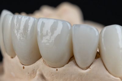 Dentist placing a custom dental crown using iTero digital impressions at Save Dental in Orem, Utah.