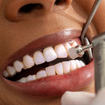 Close-up of a dental cleaning procedure removing plaque from teeth during a professional exam.