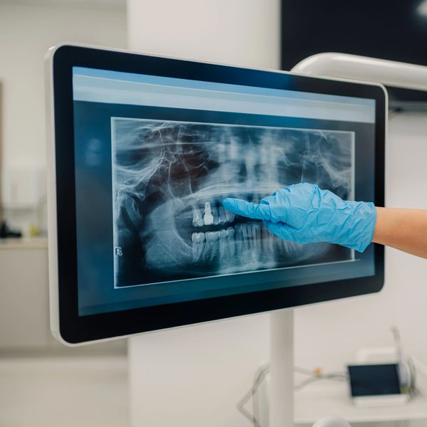 Dentist's gloved hand pointing at dental implant on dental X-ray on screen.
