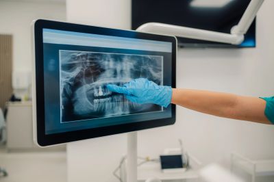 A dental professional points at a tooth on a digital X-ray screen.