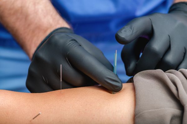 Acupuncture treatment with needles on a person's arm.