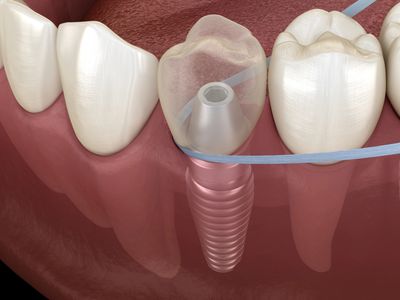Dental implant placement and crown restoration at Save Dental in Orem, Utah.