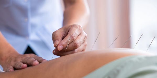 Acupuncturist inserting needles into patient's back.