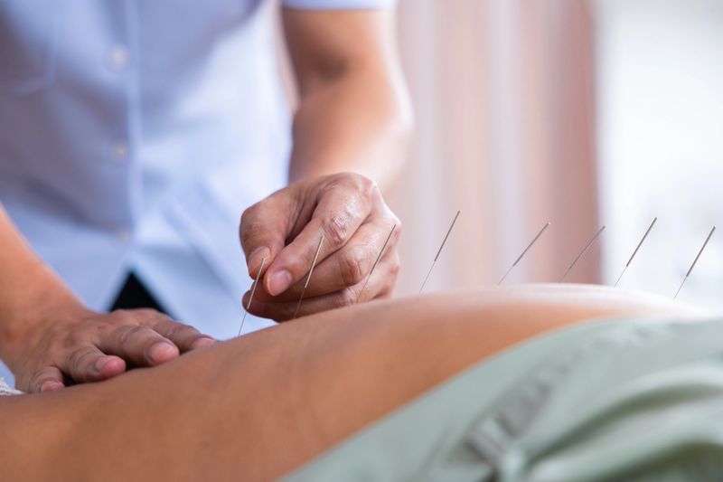 Performing acupuncture on a patients back.A close-up of a patient receiving acupuncture an treatment on the back.Acupuncture back treatment.