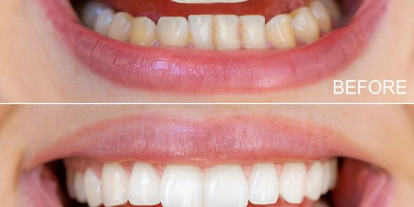 Before and after teeth whitening showing a brighter smile.