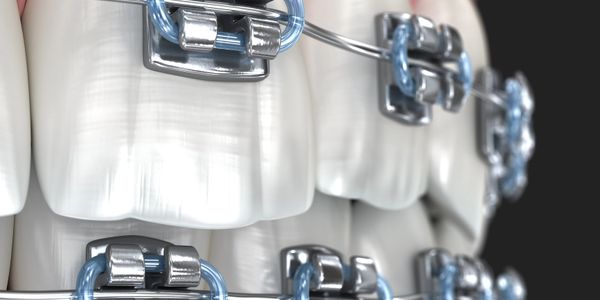 Close-up of teeth with metal braces and blue ligatures.