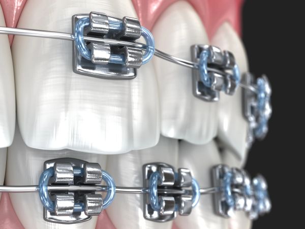Close-up of teeth with metal braces and elastic ligatures.