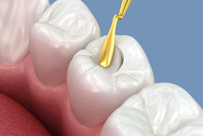Dentist placing a tooth-colored composite filling at Save Dental in Orem, Utah.