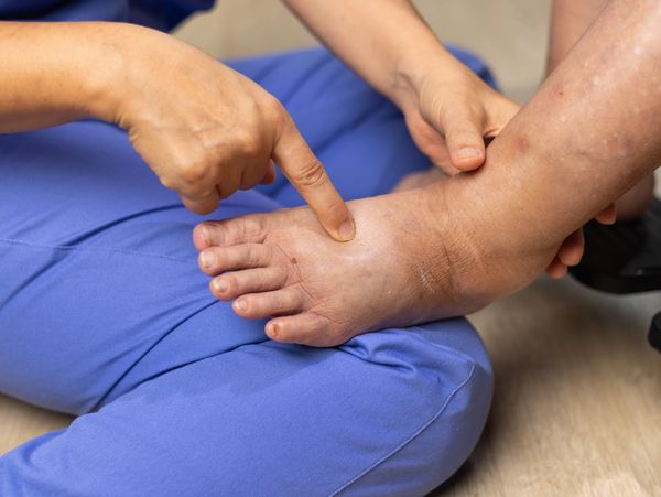 Person pointing at swollen, discolored foot and ankle, indicating inflammation or edema.