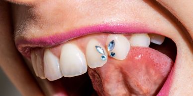 Open mouth showing a butterfly tooth gem design on the lateral and canine teeth.
