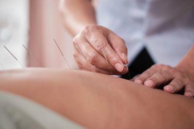 A person receiving acupuncture on their back