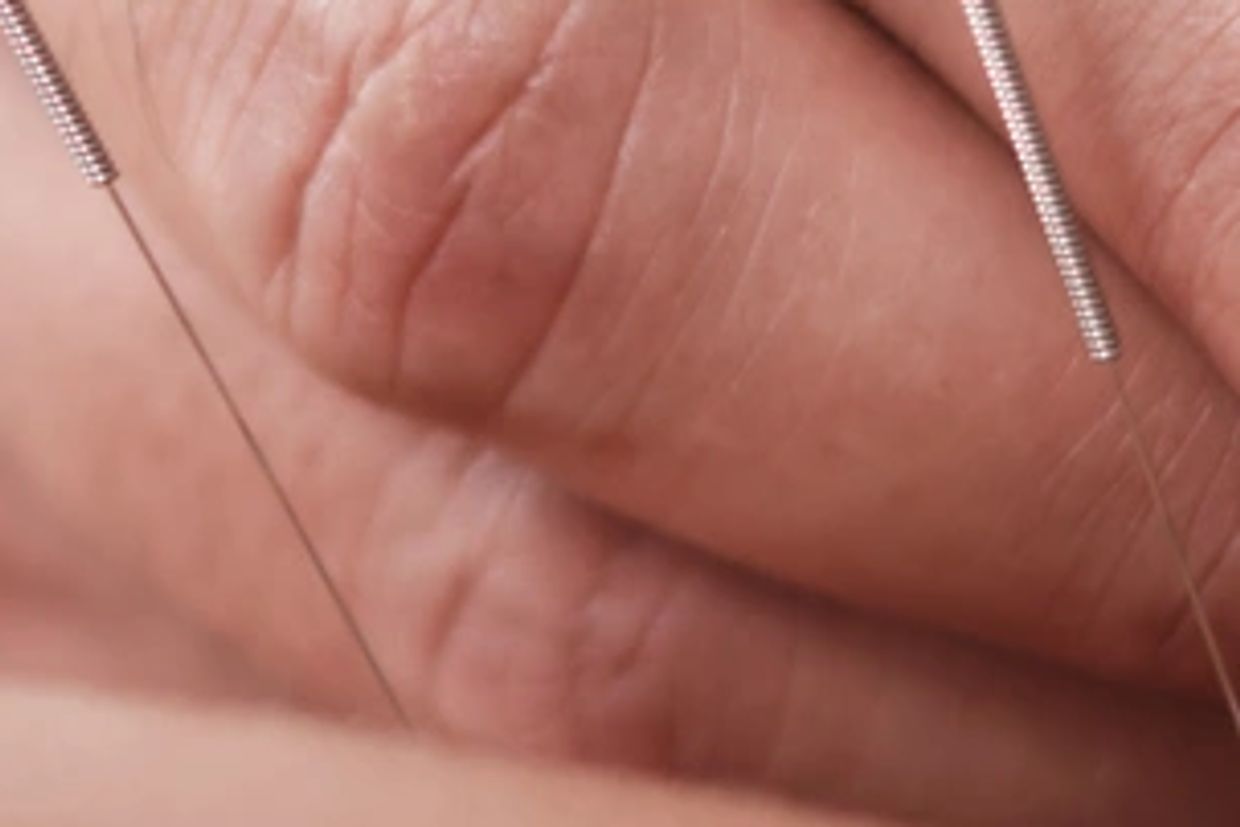 Acupuncture needles placed along the lower back to treat back pain 