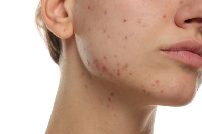 Acne treatment 