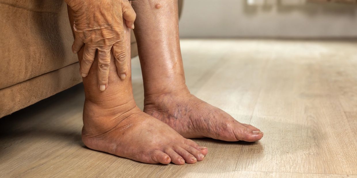 Comprendre le lymphœdème