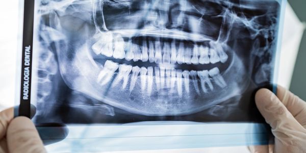 Close-up of a dental X-ray showing full set of teeth.