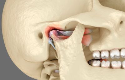 3D model of a temporomandibular joint disorder.