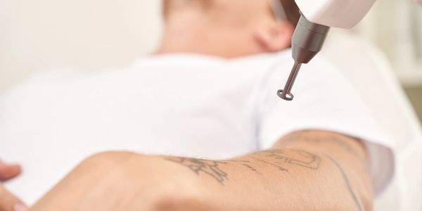 Tattoo removal 