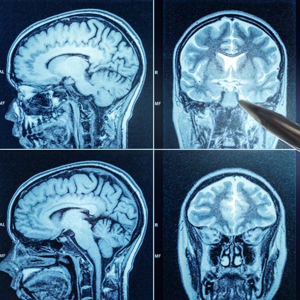 Four MRI brain scan images showing different views of the brain.