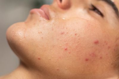 Close-up of a person's cheek with acne and blemishes.