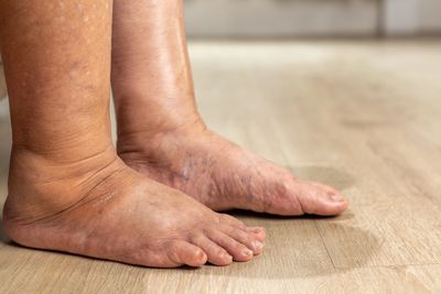 Lymphœdème : compréhension et solutions adaptées