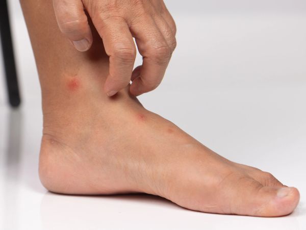 Hand scratching itchy red spots on foot.