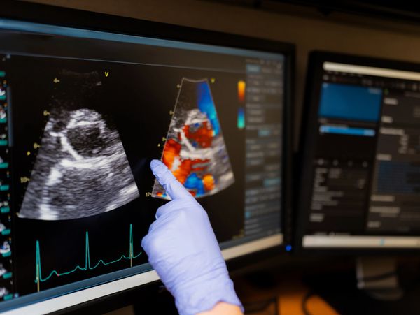Gloved hand pointing at medical ultrasound images on a computer screen.