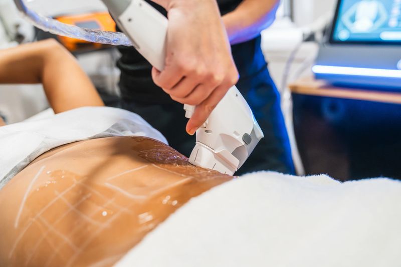 Professional performing a non-surgical hifu ultrasound treatment on a woman's abdomen for skin tightening and collagen stimulation