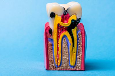Model of a tooth with cavities and infected roots.