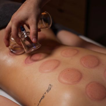 Person receiving cupping therapy on their back.
