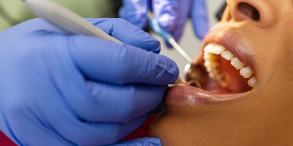 Doctor with blue gloves performing a dental exam with a mouth mirror in a patient's mouth showing te