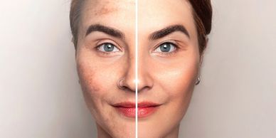 Split image showing a woman's face with skin imperfections on one side and clear skin on the other.