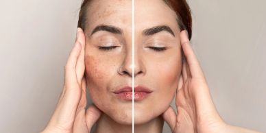 Side-by-side comparison of facial skin before and after treatment.