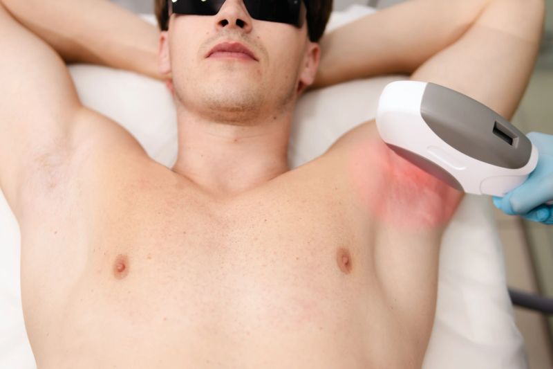 Man wearing protective goggles lying on a couch, receiving an armpit hair removal procedure with a laser device operated by a cosmetologist wearing blue gloves, indicating advanced male grooming