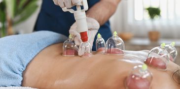 Person receiving cupping therapy on their back.