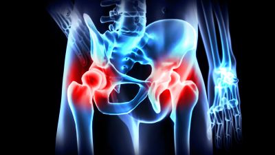 X-ray of pelvis and hip joints showing inflammation.