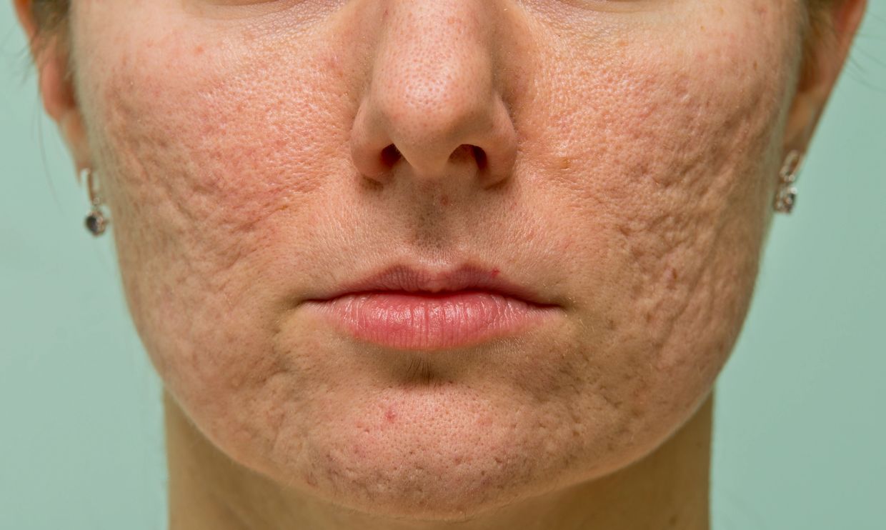 Brisbane's #1 scar minimising treatment, using fractionated laser technology to fade scarring.