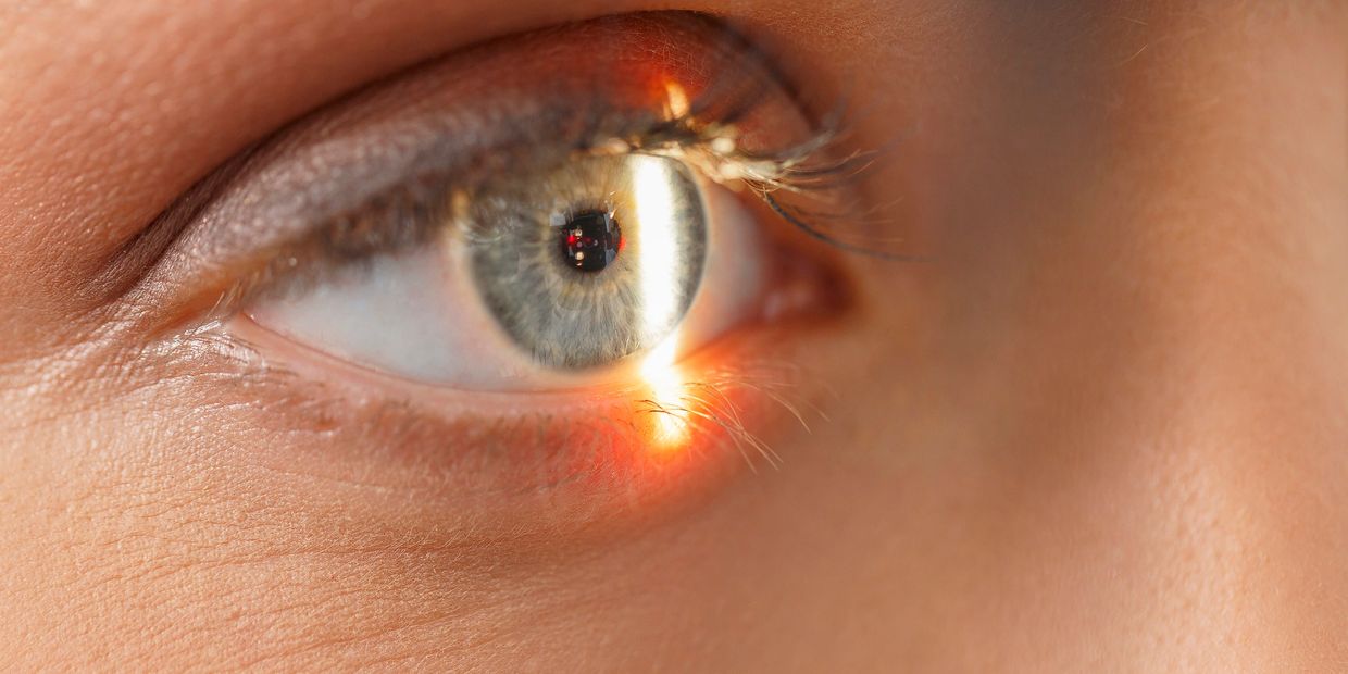 Keratopigmentation Surgery Louisiana 424-478-9157