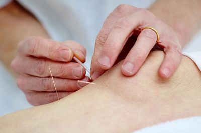 An acupuncturist inserting needles into the knee and lower leg to help with knee pain.