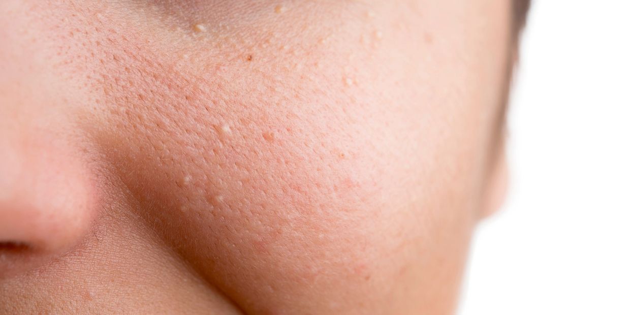 Instant milia removal to face hawarden, Deeside, Chester, wirral, before and after