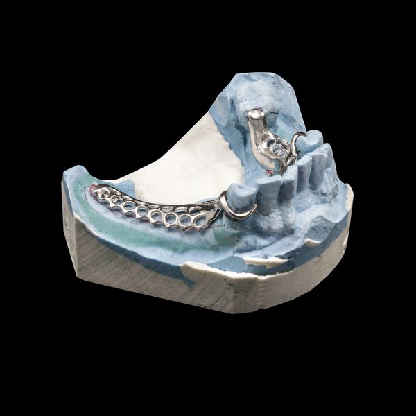 Dental model with metal framework for partial denture fitting.