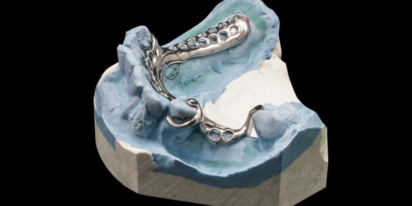 Dental mold with a metal partial denture framework on a blue base.