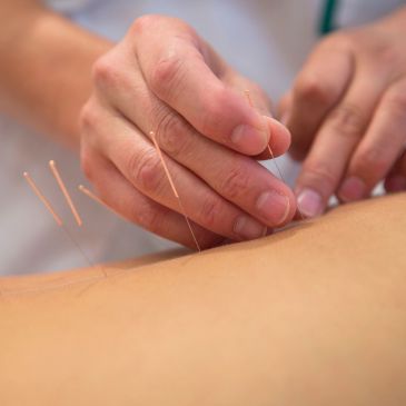 Close-up of acupuncture treatment.