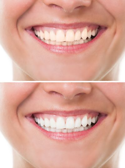 Comparison of teeth before and after whitening treatment.
