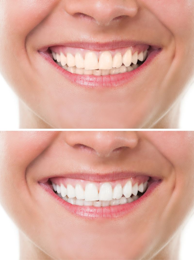 Before and after bleaching or whitening. Perfect woman mouth with teeth smile